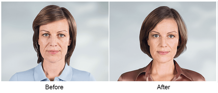 Sculptra Before and After Sculptra