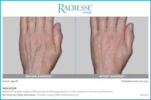 EM01634-00_RADIESSE-Hands-CON-BA4