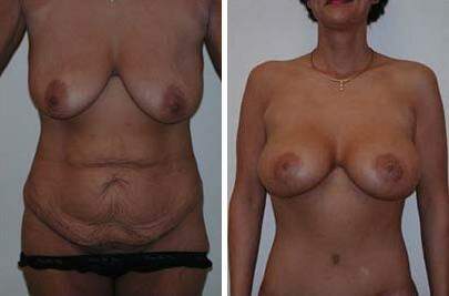 Patient 7310, Body Lift Before and After Photos Body Lift Before and After Photos in Lexington, KY, Patient 7310