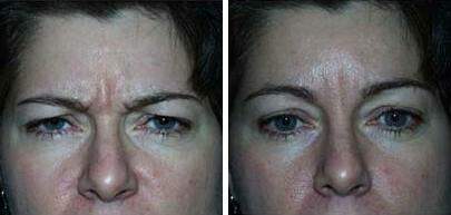 Patient 6898, Botox Before and After Photos Botox Before and After Photos in Lexington, KY, Patient 6898