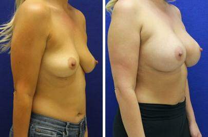 Patient 7896, Breast Augmentation Before and After Photos Breast Augmentation Before and After Photos in Lexington, KY, Patient 7896