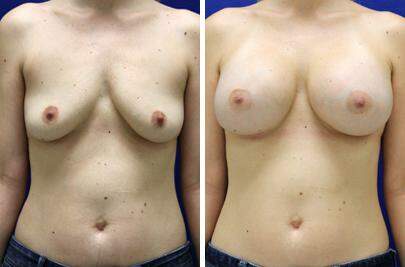 Patient 8243, Breast Augmentation Before and After Photos Breast Augmentation Before and After Photos in Lexington, KY, Patient 8243