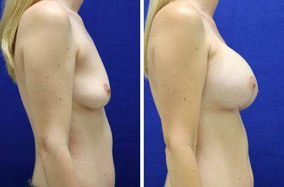 Patient 8243, Breast Augmentation Before and After Photos Breast Augmentation Before and After Photos in Lexington, KY, Patient 8243