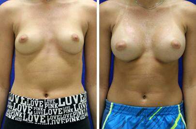Patient 8263, Breast Augmentation Before and After Photos Breast Augmentation Before and After Photos in Lexington, KY, Patient 8263