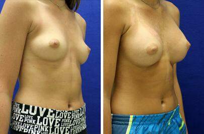 Patient 8263, Breast Augmentation Before and After Photos Breast Augmentation Before and After Photos in Lexington, KY, Patient 8263