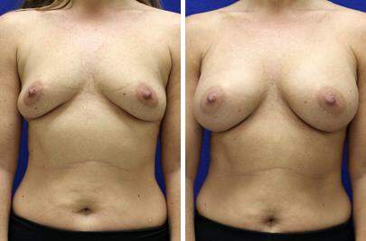 Patient 8293, Breast Augmentation Before and After Photos Breast Augmentation Before and After Photos in Lexington, KY, Patient 8293