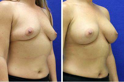 Patient 8293, Breast Augmentation Before and After Photos Breast Augmentation Before and After Photos in Lexington, KY, Patient 8293
