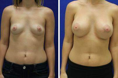Patient 7936, Breast Augmentation Before and After Photos Breast Augmentation Before and After Photos in Lexington, KY, Patient 7936