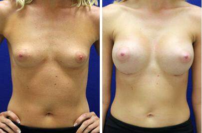 Patient 8303, Breast Augmentation Before and After Photos Breast Augmentation Before and After Photos in Lexington, KY, Patient 8303
