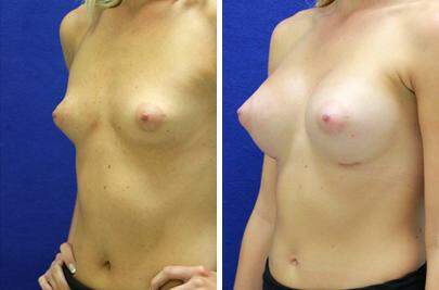 Patient 8303, Breast Augmentation Before and After Photos Breast Augmentation Before and After Photos in Lexington, KY, Patient 8303