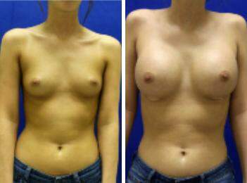 Patient 8313, Breast Augmentation Before and After Photos Breast Augmentation Before and After Photos in Lexington, KY, Patient 8313
