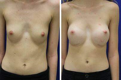 Patient 7946, Breast Augmentation Before and After Photos Breast Augmentation Before and After Photos in Lexington, KY, Patient 7946