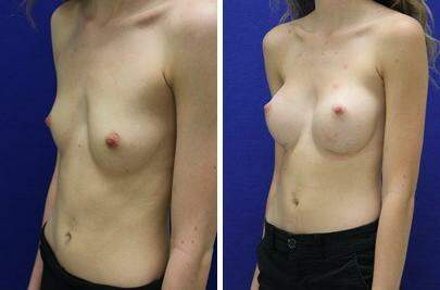 Patient 7946, Breast Augmentation Before and After Photos Breast Augmentation Before and After Photos in Lexington, KY, Patient 7946