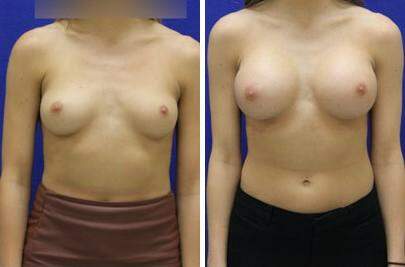 Patient 7956, Breast Augmentation Before and After Photos Breast Augmentation Before and After Photos in Lexington, KY, Patient 7956
