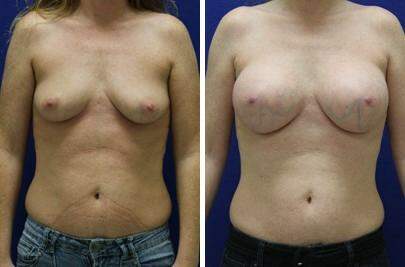 Patient 7987, Breast Augmentation Before and After Photos Breast Augmentation Before and After Photos in Lexington, KY, Patient 7987