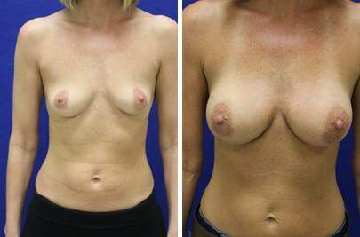 Patient 7906, Breast Augmentation Before and After Photos Breast Augmentation Before and After Photos in Lexington, KY, Patient 7906