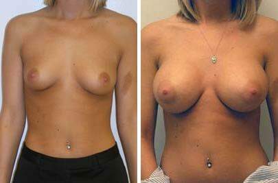 Patient 8017, Breast Augmentation Before and After Photos Breast Augmentation Before and After Photos in Lexington, KY, Patient 8017