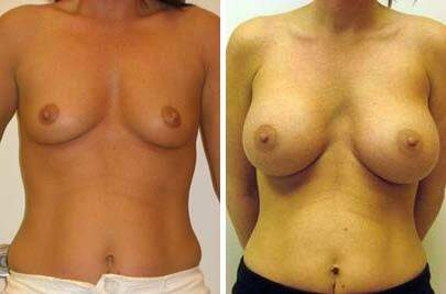 Patient 8027, Breast Augmentation Before and After Photos Breast Augmentation Before and After Photos in Lexington, KY, Patient 8027