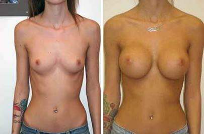 Patient 8047, Breast Augmentation Before and After Photos Breast Augmentation Before and After Photos in Lexington, KY, Patient 8047