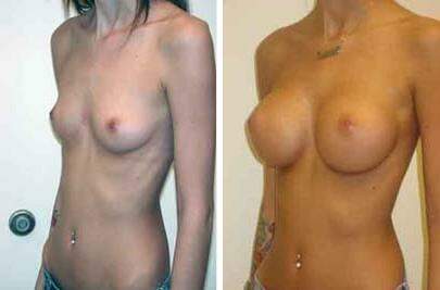 Patient 8047, Breast Augmentation Before and After Photos Breast Augmentation Before and After Photos in Lexington, KY, Patient 8047
