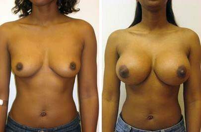 Patient 8077, Breast Augmentation Before and After Photos Breast Augmentation Before and After Photos in Lexington, KY, Patient 8077