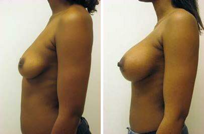 Patient 8077, Breast Augmentation Before and After Photos Breast Augmentation Before and After Photos in Lexington, KY, Patient 8077