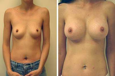 Patient 8087, Breast Augmentation Before and After Photos Breast Augmentation Before and After Photos in Lexington, KY, Patient 8087
