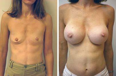 Patient 8107, Breast Augmentation Before and After Photos Breast Augmentation Before and After Photos in Lexington, KY, Patient 8107