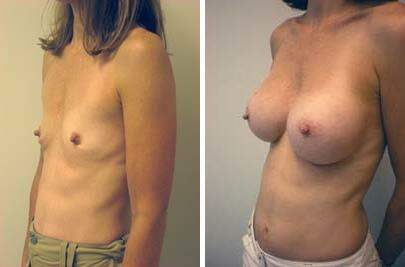 Patient 8107, Breast Augmentation Before and After Photos Breast Augmentation Before and After Photos in Lexington, KY, Patient 8107