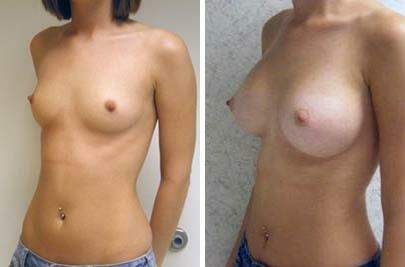 Patient 8127, Breast Augmentation Before and After Photos Breast Augmentation Before and After Photos in Lexington, KY, Patient 8127
