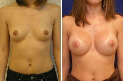 Patient 8137, Breast Augmentation Before and After Photos Breast Augmentation Before and After Photos in Lexington, KY, Patient 8137