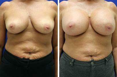 Patient 8147, Breast Augmentation Before and After Photos Breast Augmentation Before and After Photos in Lexington, KY, Patient 8147
