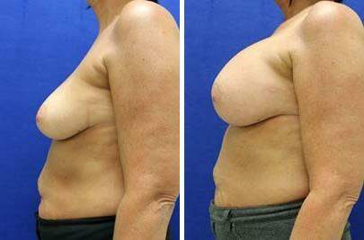 Patient 8147, Breast Augmentation Before and After Photos Breast Augmentation Before and After Photos in Lexington, KY, Patient 8147