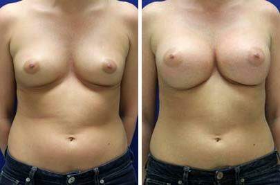 Patient 8167, Breast Augmentation Before and After Photos Breast Augmentation Before and After Photos in Lexington, KY, Patient 8167