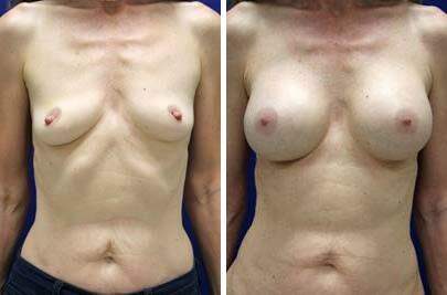 Patient 8177, Breast Augmentation Before and After Photos Breast Augmentation Before and After Photos in Lexington, KY, Patient 8177