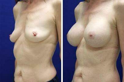 Patient 8177, Breast Augmentation Before and After Photos Breast Augmentation Before and After Photos in Lexington, KY, Patient 8177