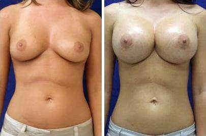 Patient 8193, Breast Augmentation Before and After Photos Breast Augmentation Before and After Photos in Lexington, KY, Patient 8193