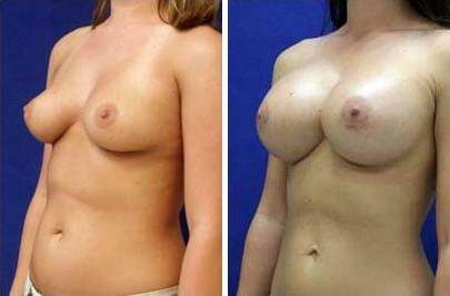 Patient 8193, Breast Augmentation Before and After Photos Breast Augmentation Before and After Photos in Lexington, KY, Patient 8193