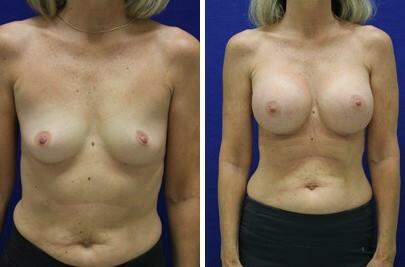 Patient 7926, Breast Augmentation Before and After Photos Breast Augmentation Before and After Photos in Lexington, KY, Patient 7926