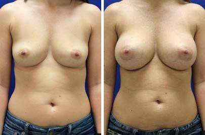 Patient 8213, Breast Augmentation Before and After Photos Breast Augmentation Before and After Photos in Lexington, KY, Patient 8213