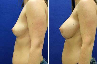 Patient 8213, Breast Augmentation Before and After Photos Breast Augmentation Before and After Photos in Lexington, KY, Patient 8213