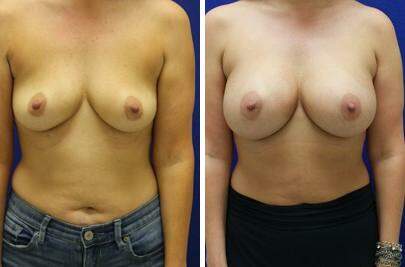 Patient 7896, Breast Augmentation Before and After Photos Breast Augmentation Before and After Photos in Lexington, KY, Patient 7896