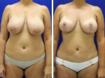 Patient 7876, Breast Lift Before and After Photos Breast Lift Before and After Photos in Lexington, KY, Patient 7876