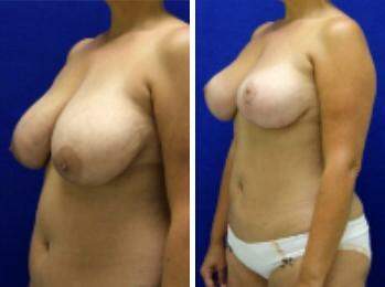 Patient 7876, Breast Lift Before and After Photos Breast Lift Before and After Photos in Lexington, KY, Patient 7876