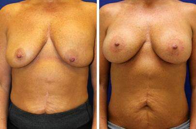 Patient 7886, Breast Lift Before and After Photos Breast Lift Before and After Photos in Lexington, KY, Patient 7886