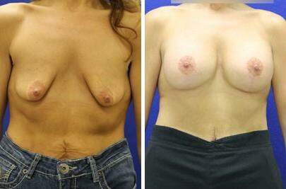 Patient 7826, Breast Lift with Implants Before and After Photos Breast Lift with Implants Before and After Photos in Lexington, KY, Patient 7826