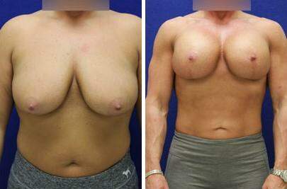 Patient 7784, Breast Lift with Implants Before and After Photos Breast Lift with Implants Before and After Photos in Lexington, KY, Patient 7784