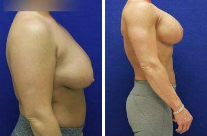 Patient 7784, Breast Lift with Implants Before and After Photos Breast Lift with Implants Before and After Photos in Lexington, KY, Patient 7784