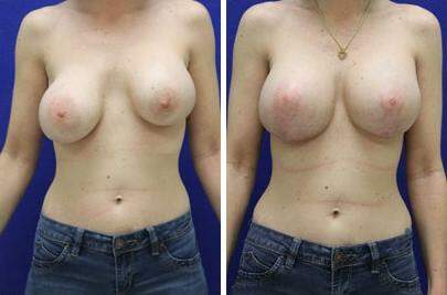 Patient 7794, Breast Lift with Implants Before and After Photos Breast Lift with Implants Before and After Photos in Lexington, KY, Patient 7794