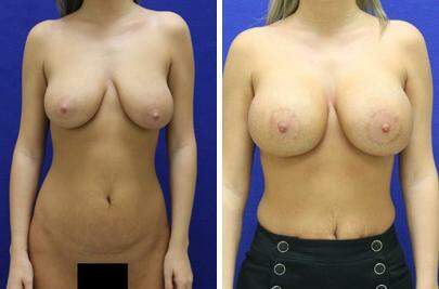 Patient 7764, Breast Lift with Implants Before and After Photos Breast Lift with Implants Before and After Photos in Lexington, KY, Patient 7764
